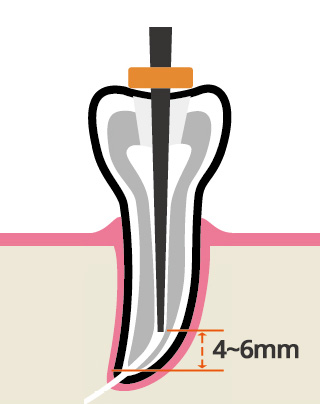 Вертикальная конденсация - подбор плаггера